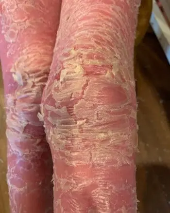 Luciana em tratamento